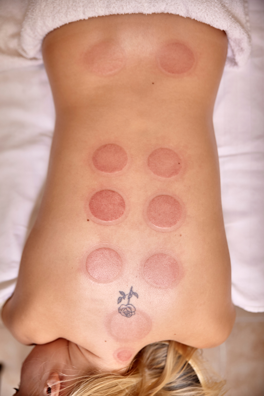 red vacuum spots, cupping therapy, 